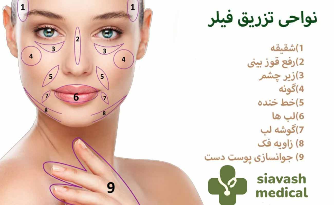 نواحی تزریق فیلر